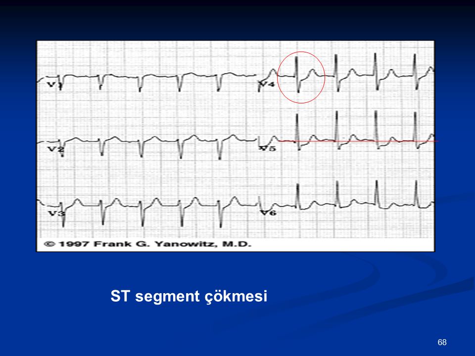 Ekg Elektrokard Yograf Elektrokardiogram Ekg Kalbin Elektriksel