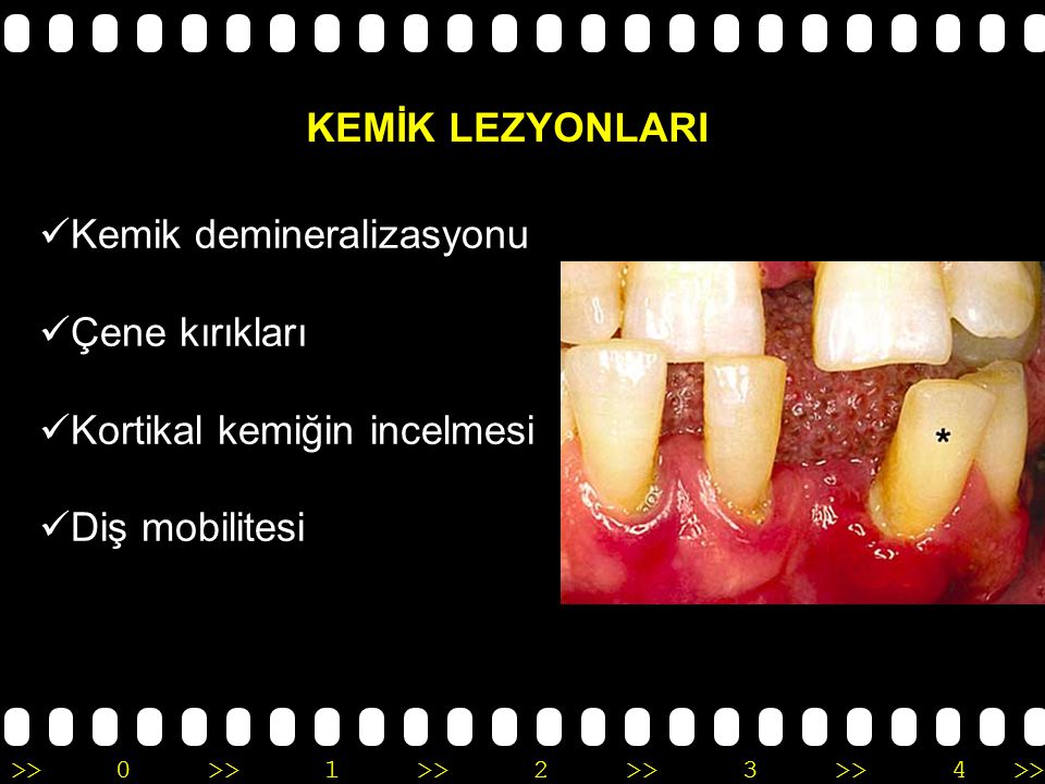 >>0 >>1 >> 2 >> 3 >> 4 >> Diş yapısında bozukluk Yetişkin hastalarda pulpa odasında daralma veya kalsifikasyonlar izlenmektedir.