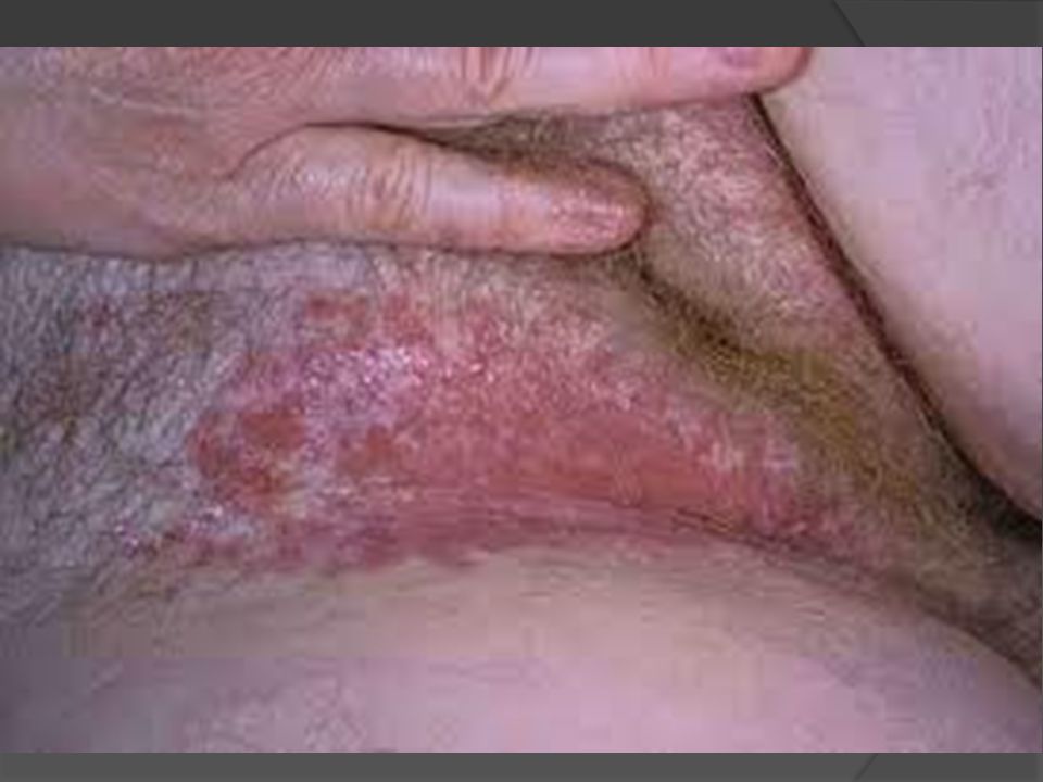 Vaginal discharge without itching
