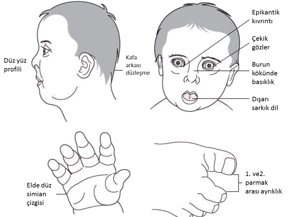 Фенотип ребенка с синдромом дауна. Характерные признаки проявления болезни синдрома Дауна. Симптомокомплекс при синдроме Дауна. Синдром Дауна поперечная ладонная складка.