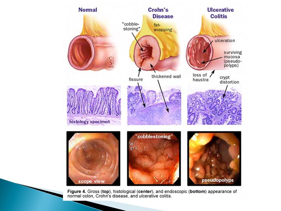 Fases de la colitis ulcerosa