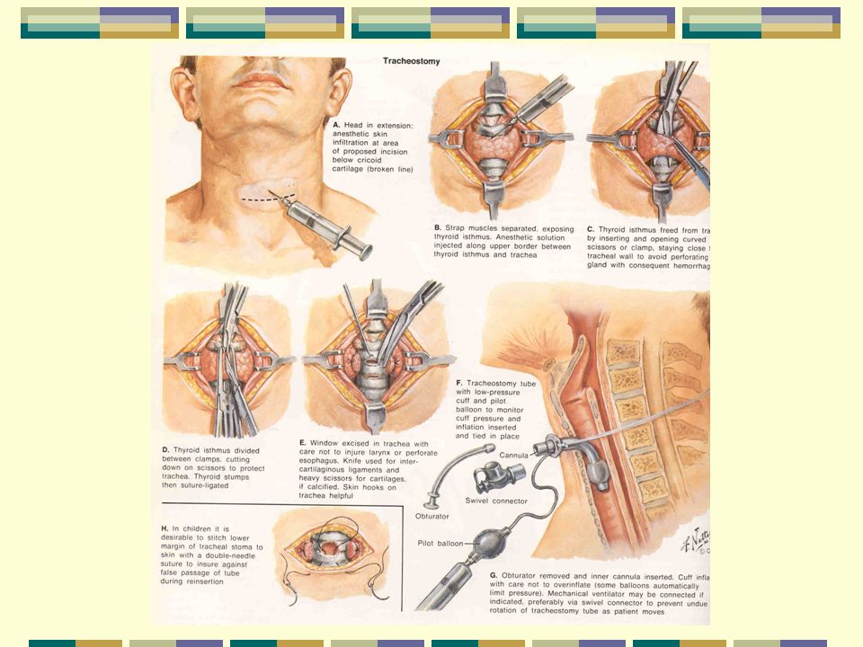 Трахеостомия. Этапы нижней трахеостомии. Трахеостомия топографическая анатомия. Трахеостомия ход операции.