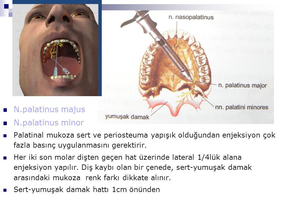 N.palatinus majus N.palatinus minor Palatinal mukoza sert ve periosteuma yapışık olduğundan enjeksiyon çok fazla basınç uygulanmasını gerektirir.