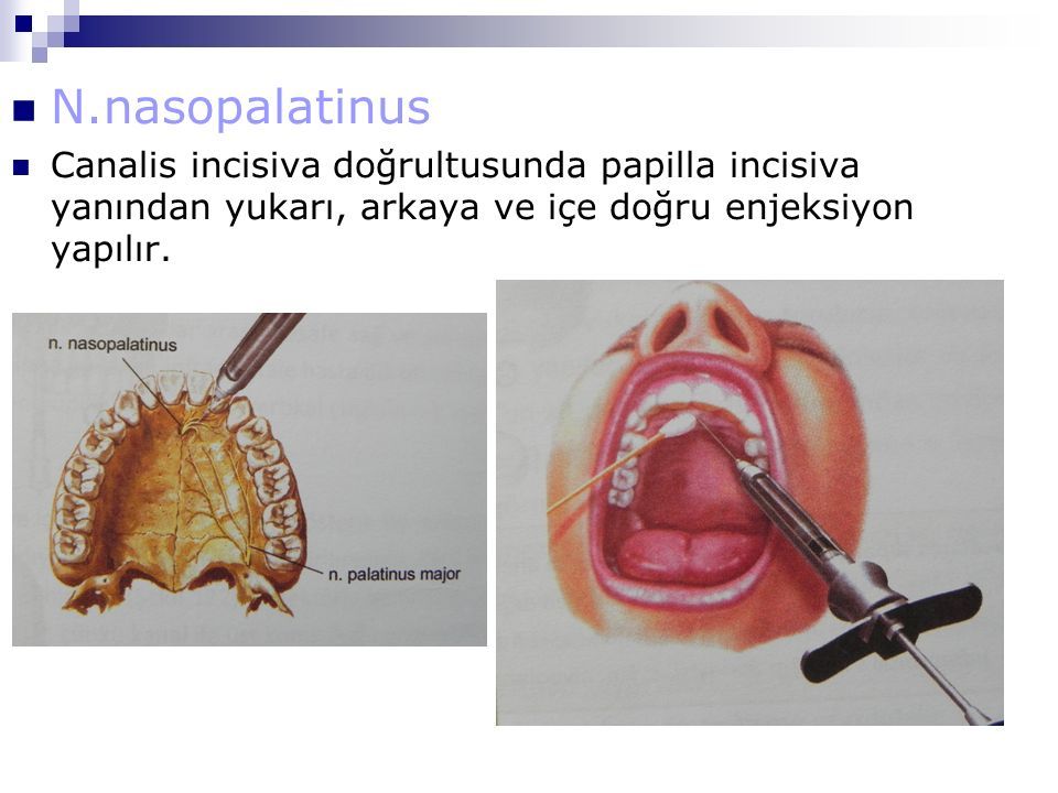 N.nasopalatinus Canalis incisiva doğrultusunda papilla incisiva yanından yukarı, arkaya ve içe doğru enjeksiyon yapılır.