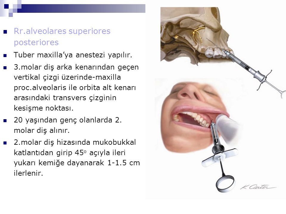 Rr.alveolares superiores posteriores Tuber maxilla’ya anestezi yapılır.