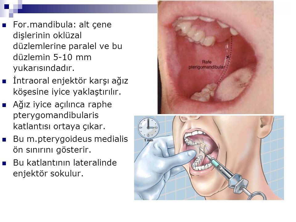For.mandibula: alt çene dişlerinin oklüzal düzlemlerine paralel ve bu düzlemin 5-10 mm yukarısındadır.