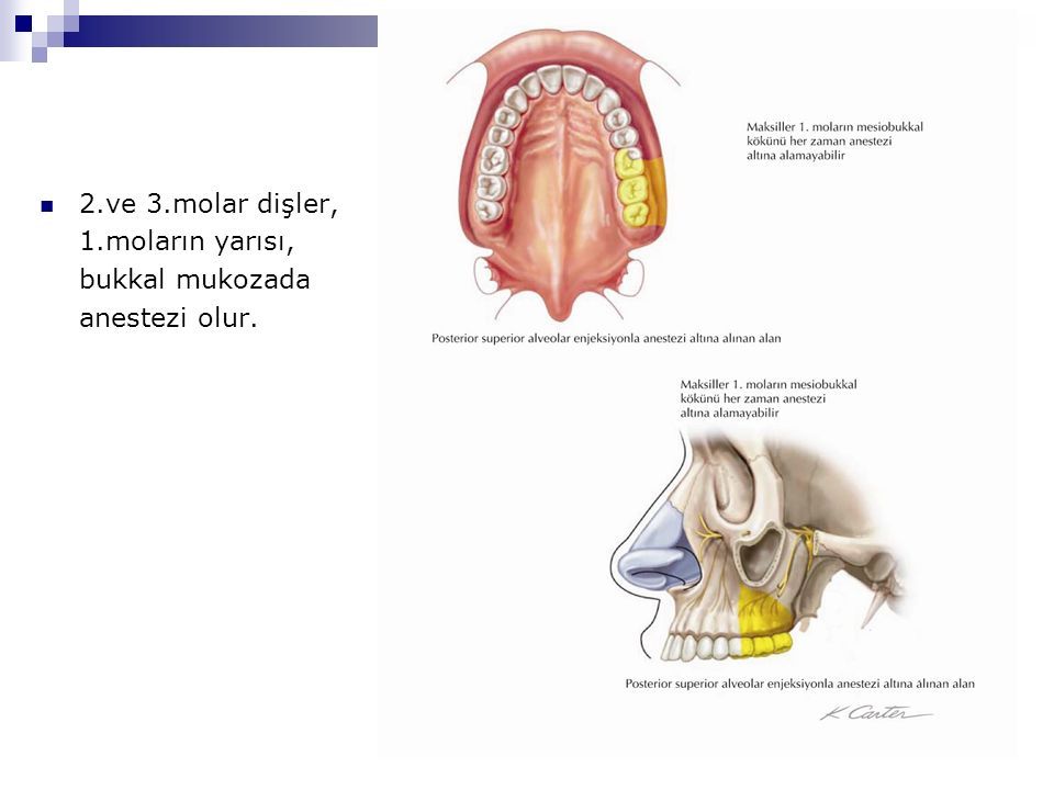 2.ve 3.molar dişler, 1.moların yarısı, bukkal mukozada anestezi olur.