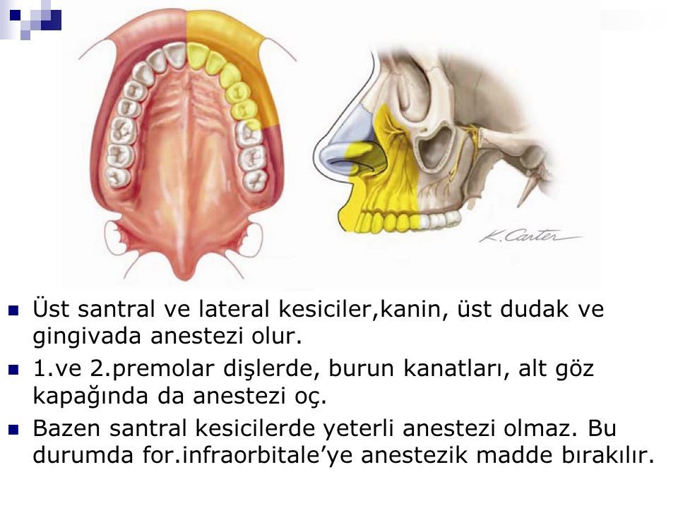Üst santral ve lateral kesiciler,kanin, üst dudak ve gingivada anestezi olur.